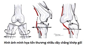 Tổn thương nhiều dây chằng khớp gối do chấn thương: những thách thức trong chẩn đoán và điều trị
